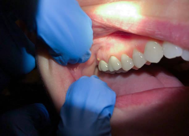 Best Emergency Dental Care for Broken or Chipped Teeth in Greenfields, PA