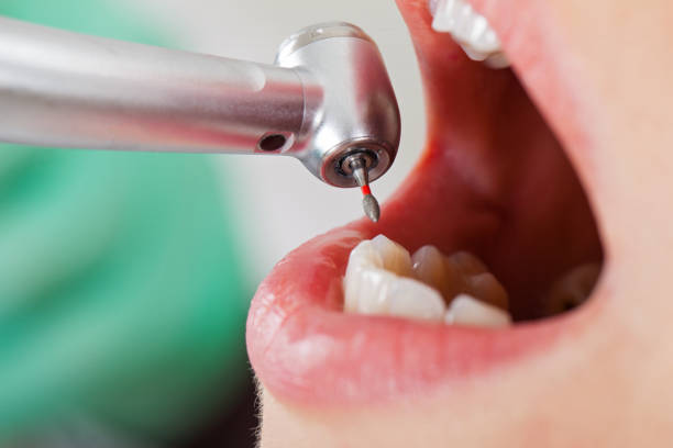 Best Emergency Treatment for Dental Infections or Abscesses in Greenfields, PA